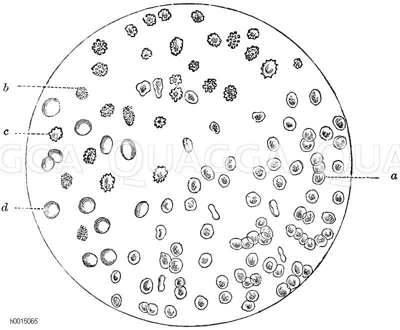 Blutkörperchen im Harn. a) Blutkörperchen mit einer Delle, b, c) geschrumpfte Blutkörperchen, d) aufgequollene Blutkörperchen [Digital]