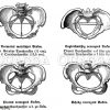 Weibliches Becken: Normal und verengte Formen