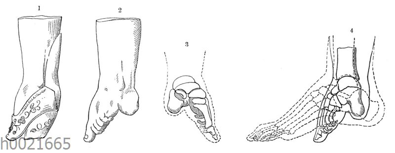 Klumpfuß einer Chinesin