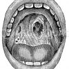 Syphilis: Durchlöcherung des harten Gaumens