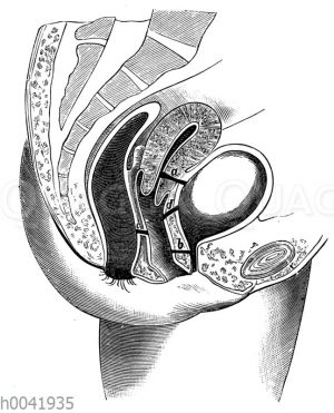Schematische Darstellung der Gebärmutterscheidenfisteln