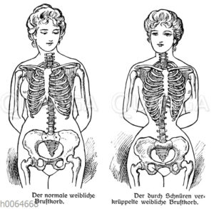 Schädigung des weiblichen Körpers durch das Korsett