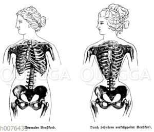 Schädigung des weiblichen Körpers durch das Korsett
